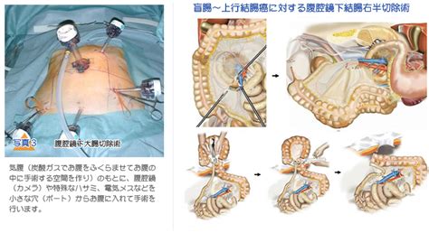 性転換大腸法|S字結腸法